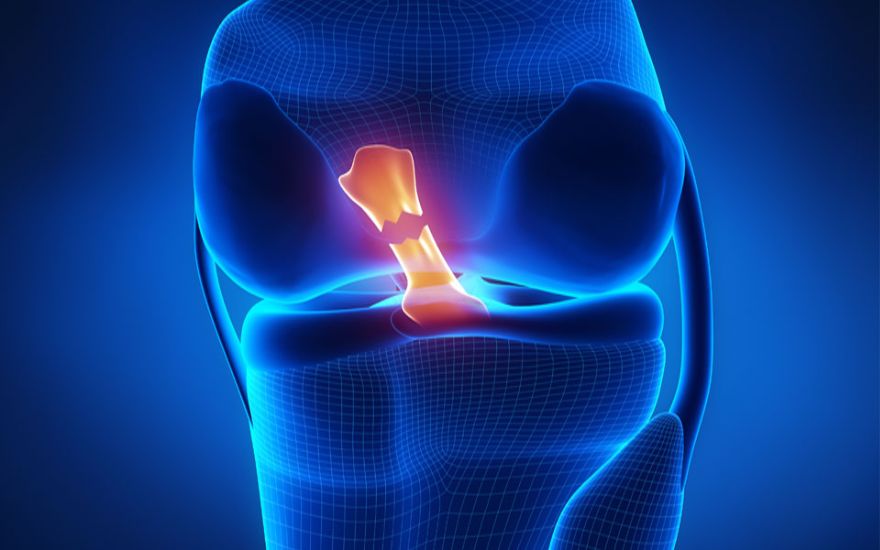 전방십자인대 파열 삽화