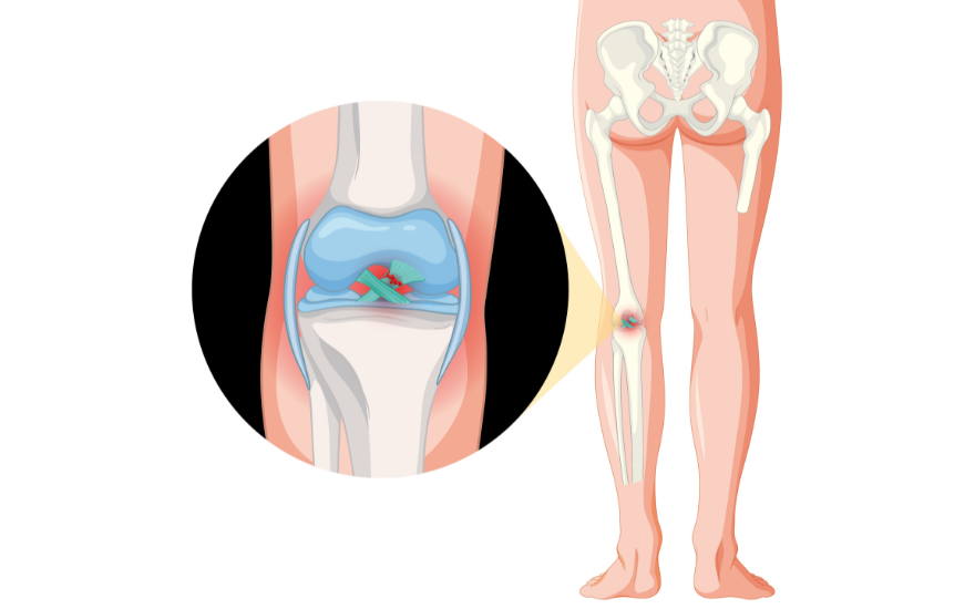 무릎 인대 파열은 무릎 관절의 운동 기능에 큰 지장을 줄 수 있습니다.