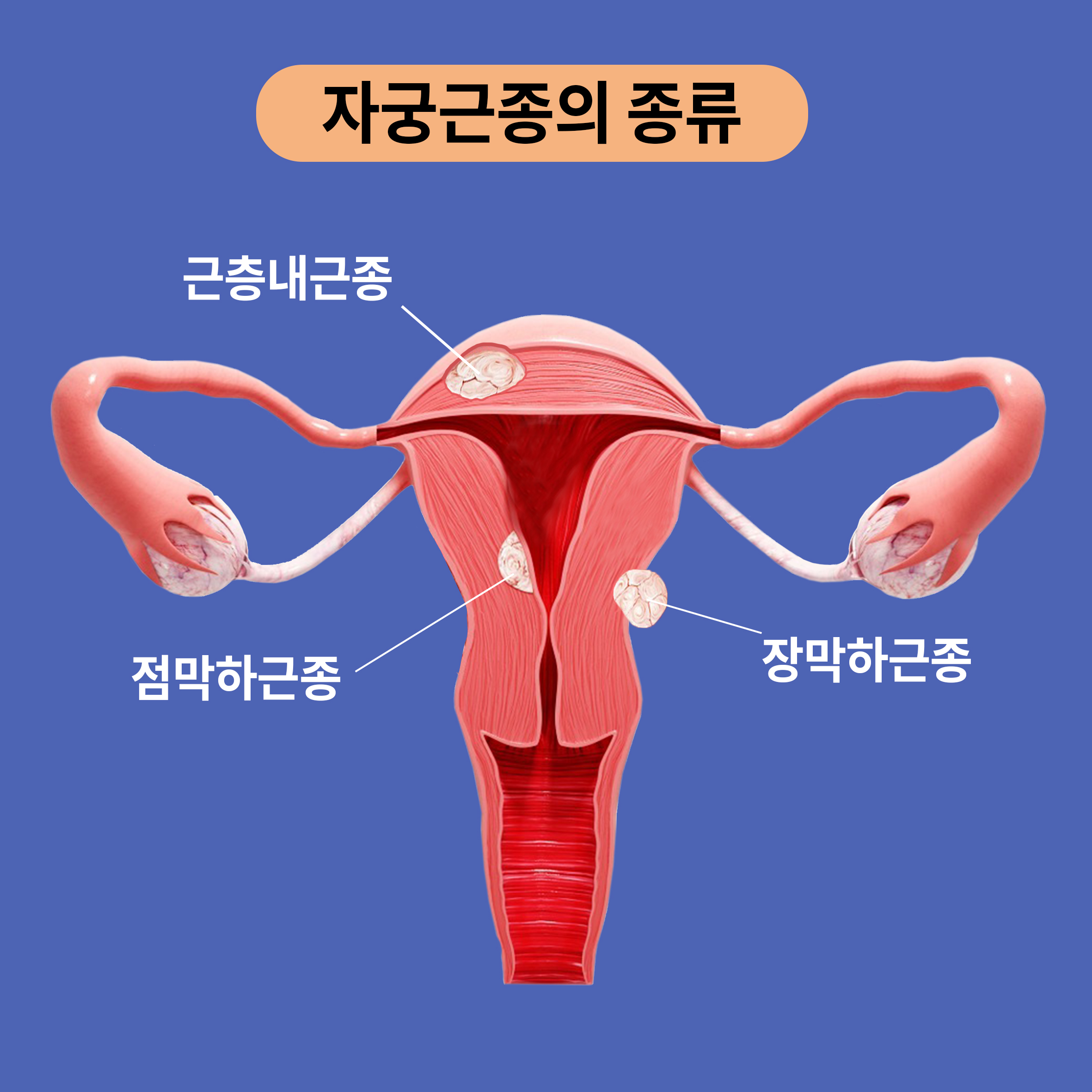 자궁근종의 위치