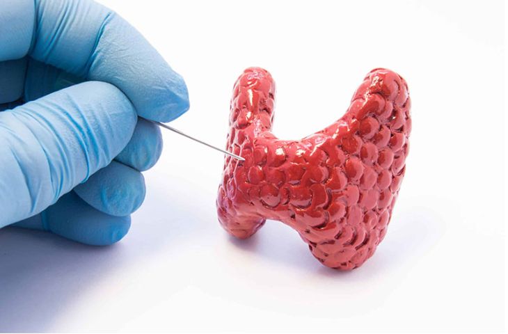 의사가 미세 바늘(FNA)을 이용해 종양에서 세포액을 채취하고 있습니다.