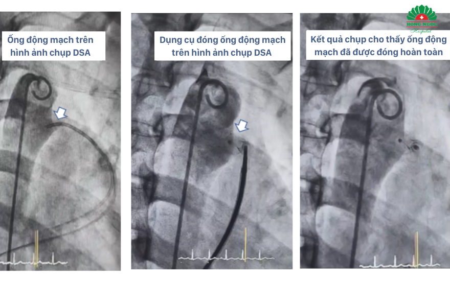 중재술 전후의 DSA 촬영 영상