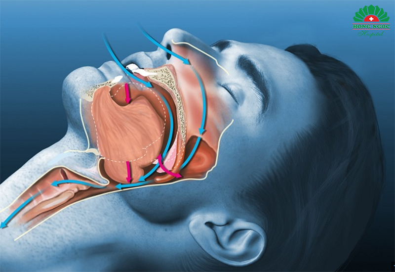 기도 폐쇄는 수면 중 정상적인 호흡 활동을 방해합니다.