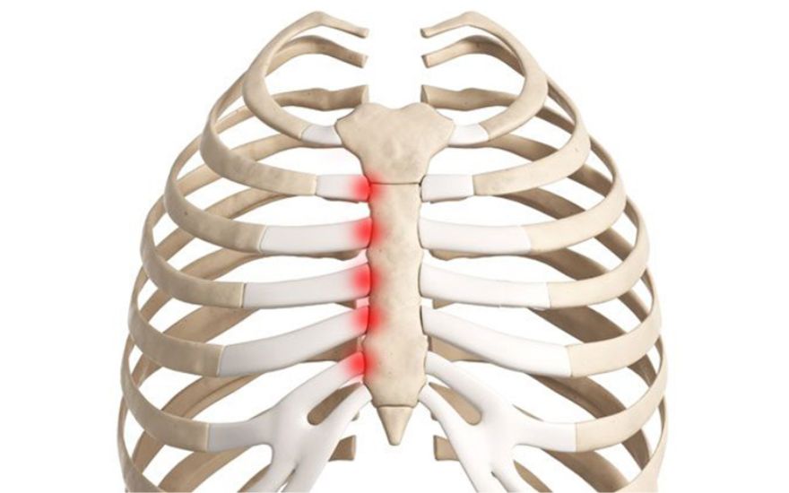 티체 증후군은 갈비뼈와 가슴뼈를 잇는 연골 부위에 염증이 발생하는 것이 특징입니다.