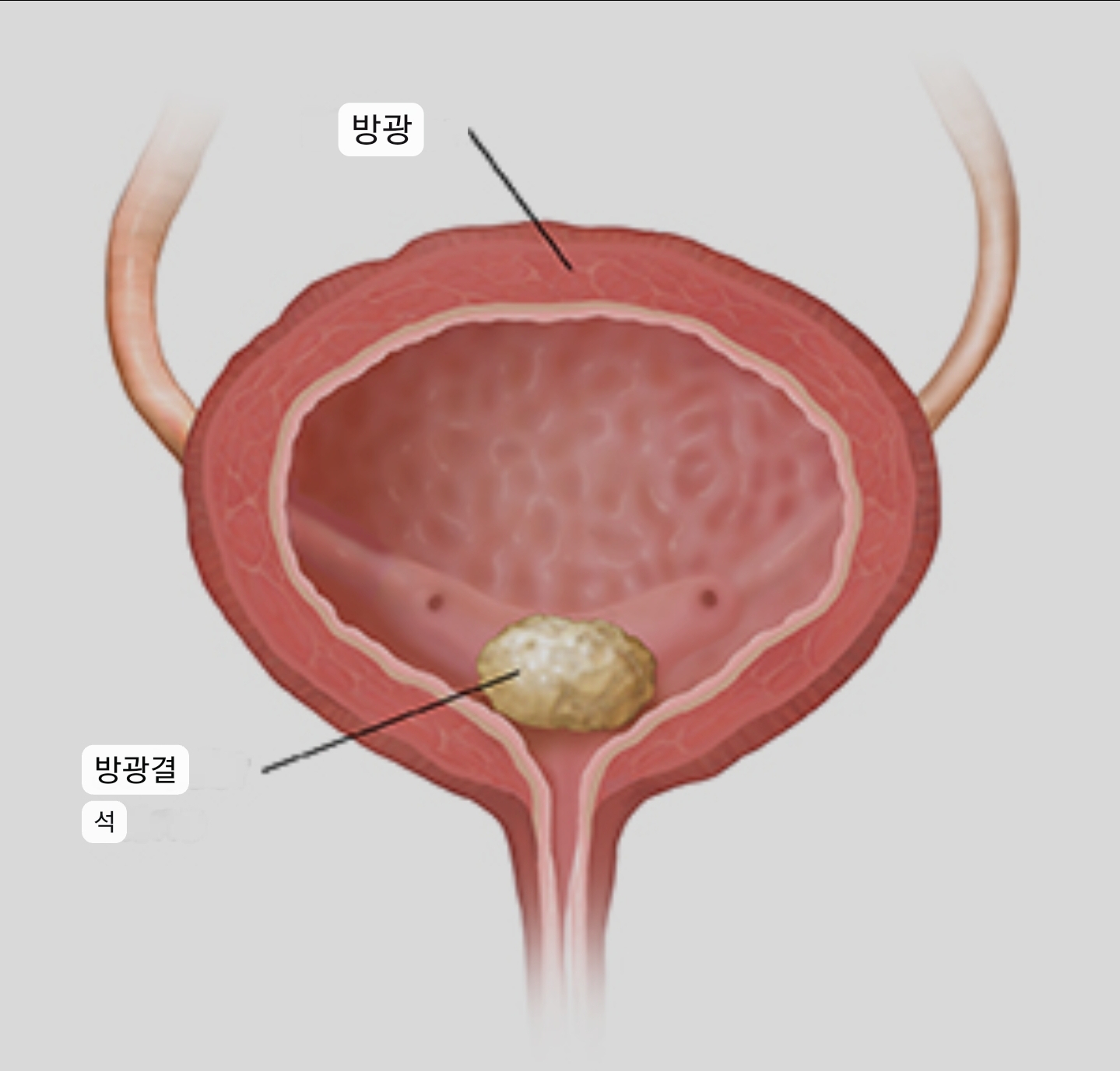 신장에서 요도로 하행한 결석을 요도결석이라고 합니다.