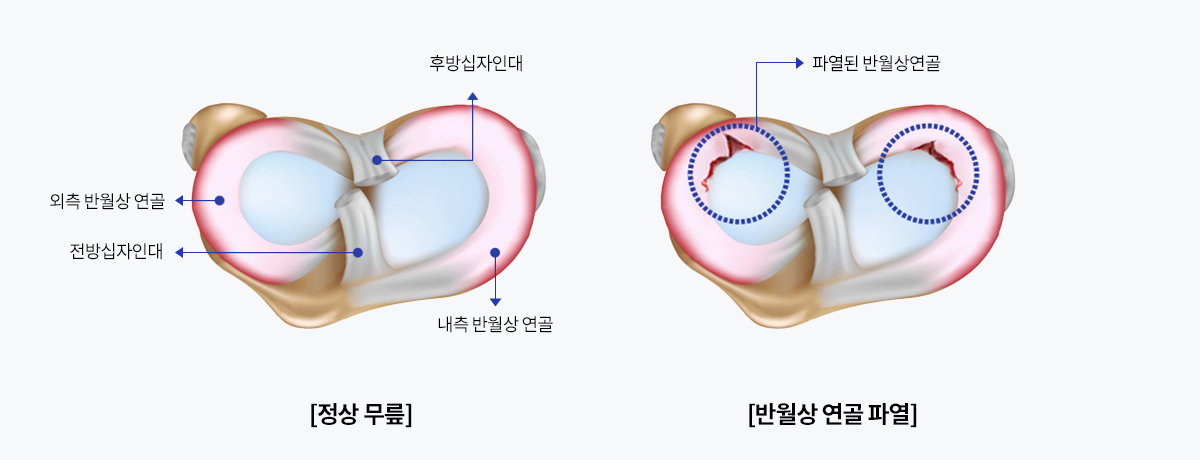 무릎 반월상 연골판 파열은 흔한 무릎 부상입니다.
