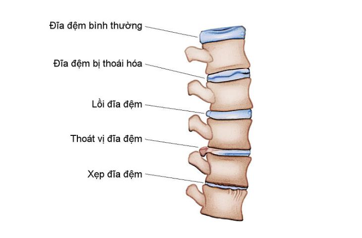 추간판 돌출증은 경미한 수준의 디스크 손상 형태입니다.