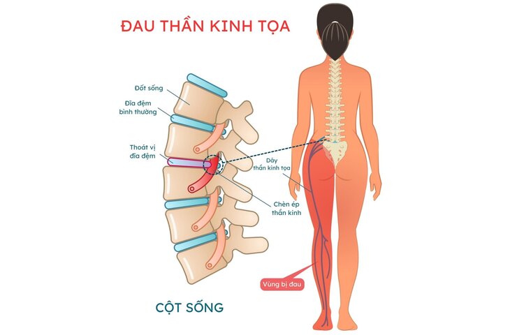 좌골신경통의 가장 큰 원인은 허리 디스크에 의한 신경 압박입니다.