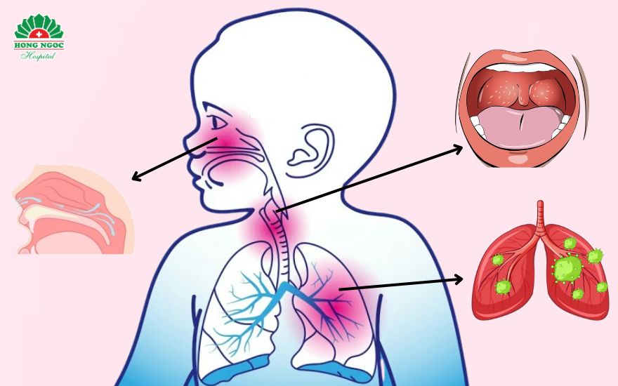 Respiratory tract infection is a condition that causes damage to the organs of the respiratory system.