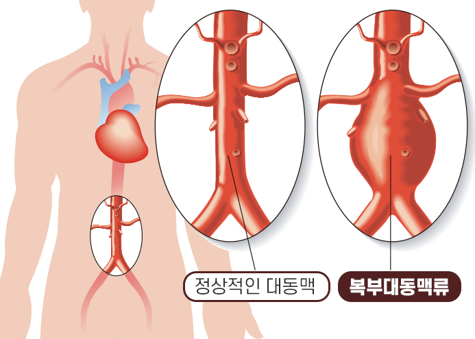 대동맥류는 조기 발견이 중요한 위험한 심혈관 질환입니다.