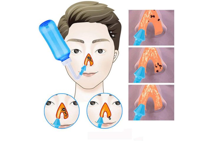 부비동염 합병증을 예방하기 위해 코와 부비동을 올바르게 세척하는 것이 좋습니다.