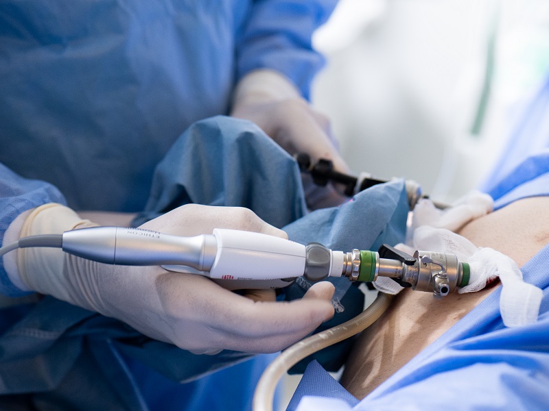 레이저 쇄석술로 수백 개의 신장 결석을 성공적으로 제거합니다. 