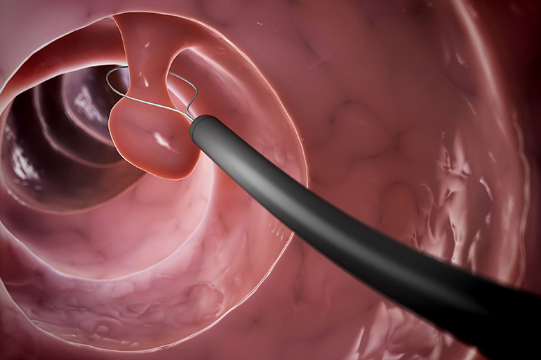 Polyp Dai Trang 1 2