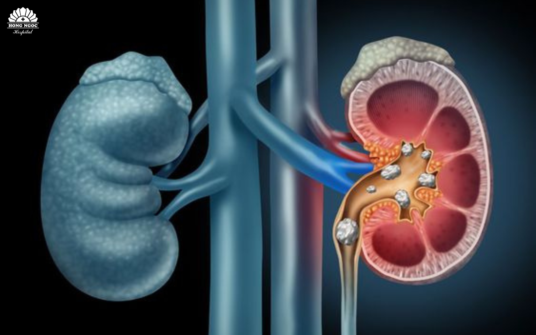 요로 결석 이미지
