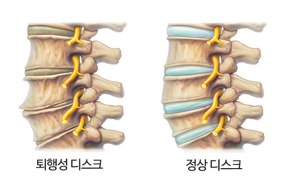 경추 퇴행성 관절염
