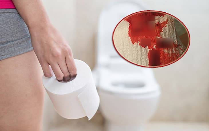 변비 혈변의 위험군