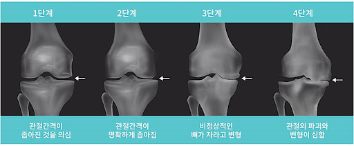 무릎 관절염은 연골이 얇아지고 뼈에 돌기(골극)가 형성되면서 통증을 유발합니다