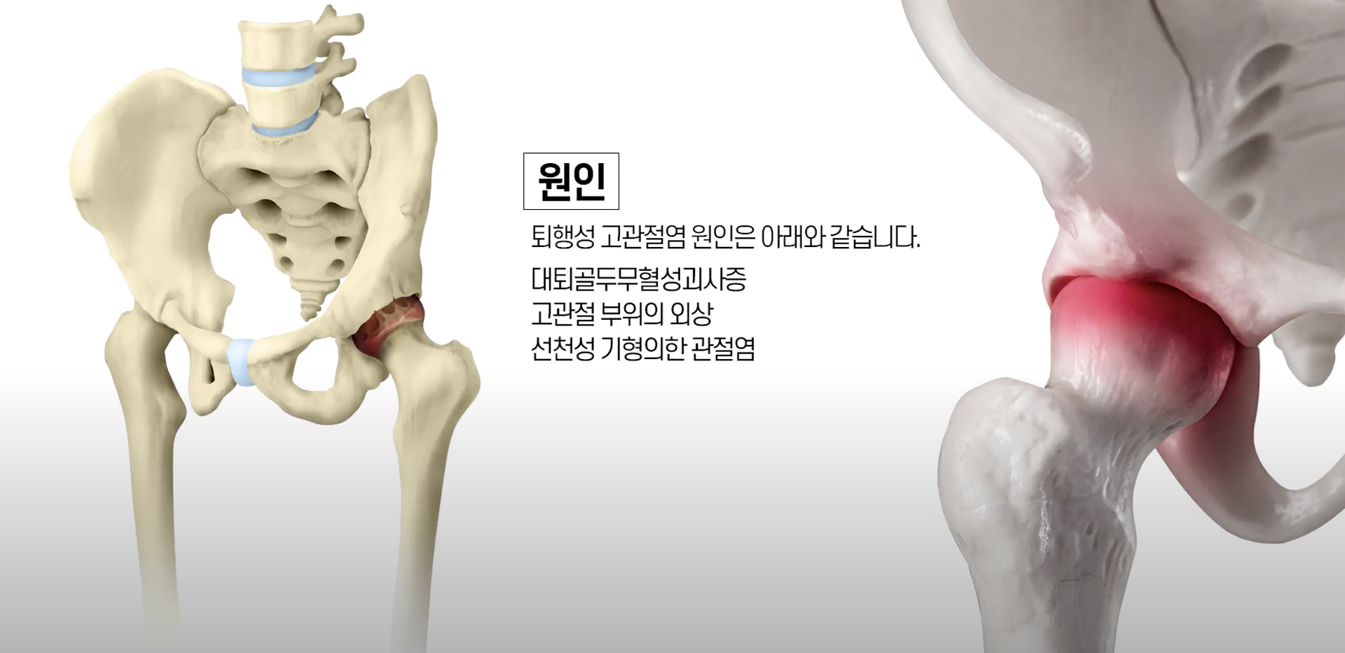 고관절 퇴행성 관절염의 주요 원인