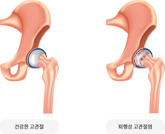 고관절 연골이 마모되면 골반과 대퇴골 사이의 마찰로 인해 극심한 통증과 보행 장애가 발생합니다