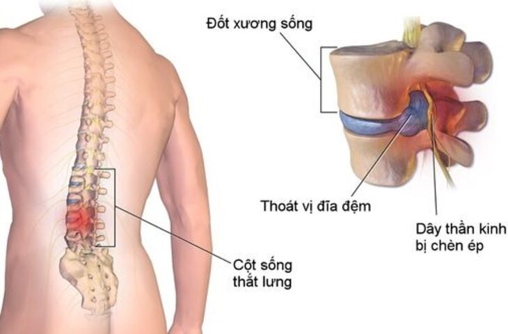 디스크 탈출증은 신경 압박으로 인해 지속적인 통증을 유발합니다.