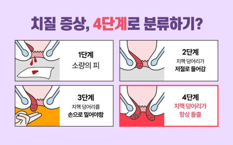 4도 치질의 주요 증상