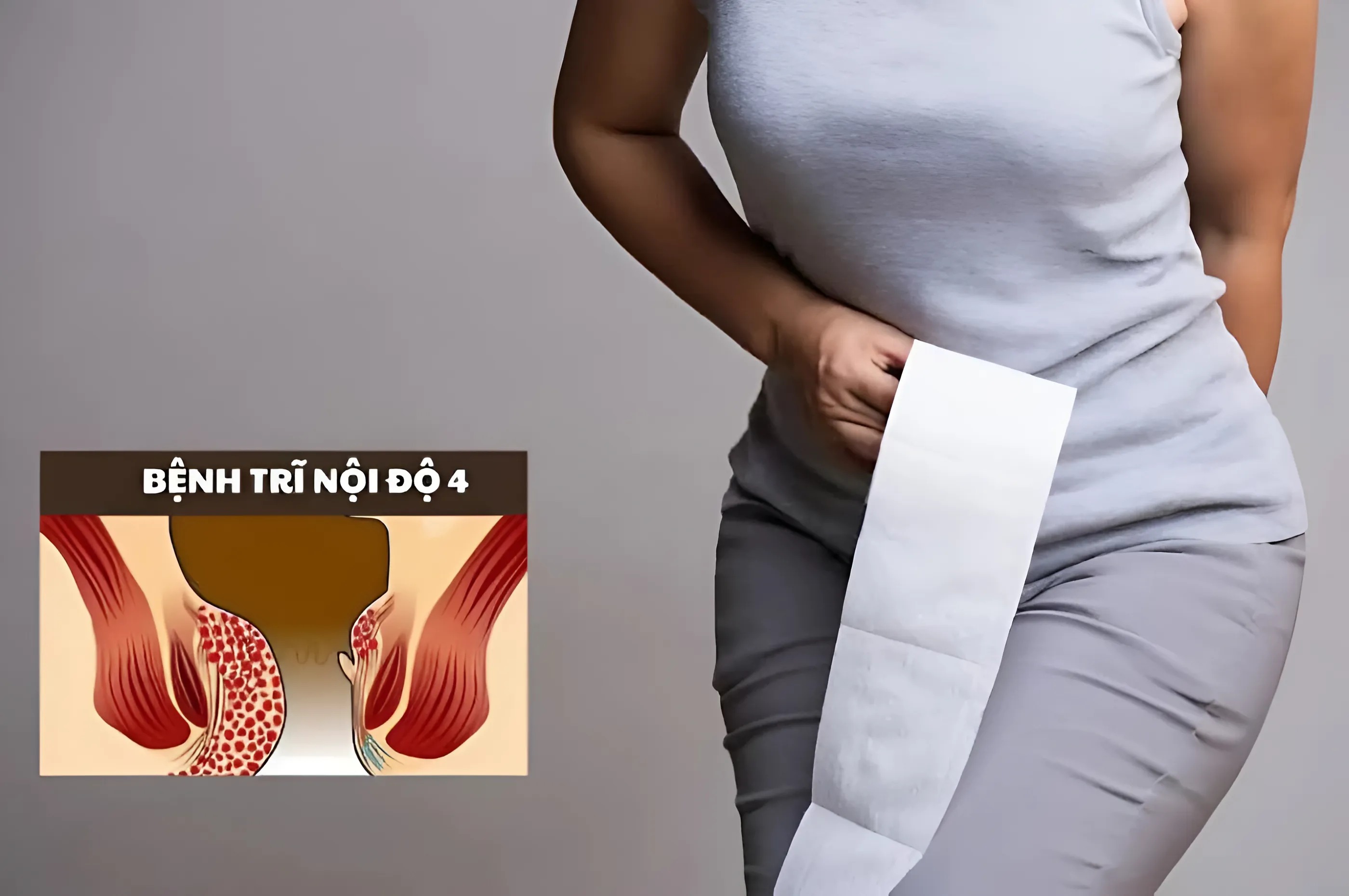 4도 치질의 위험한 합병증