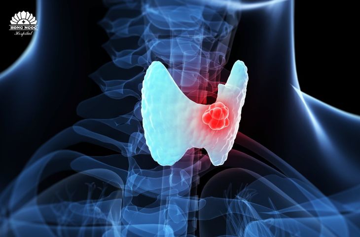 갑상선 낭종이 커지면 기침, 쉰 목소리, 인후통 등을 유발할 수 있습니다.