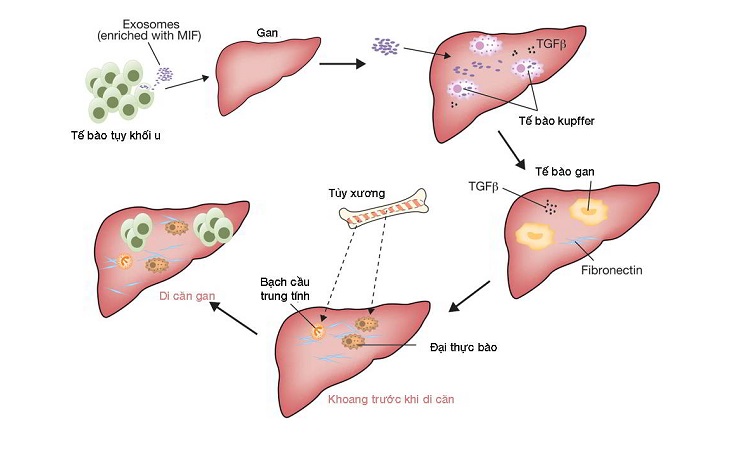 원발성 간암은 5개 단계에 걸쳐 진행됩니다.