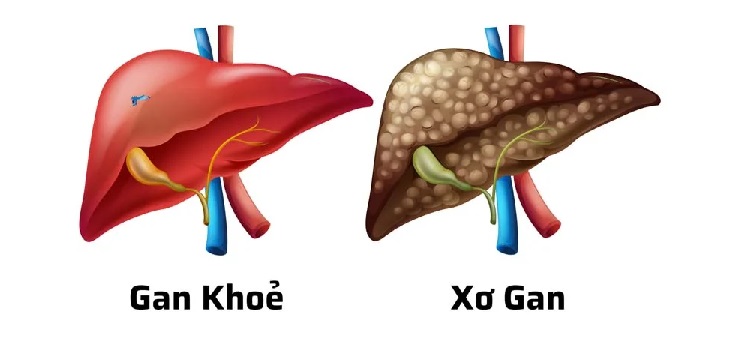 간경변 환자는 일반인보다 간암 발생 위험이 높습니다.