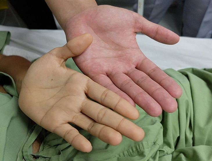 황달은 간암의 전형적인 증상 중 하나입니다.