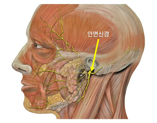 안면마비는 제7뇌신경(안면신경)의 말초성 마비입니다.