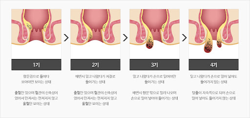 치질은 다양한 단계로 나뉩니다