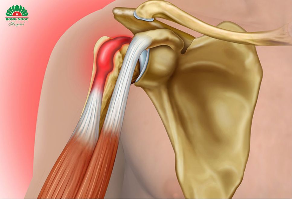 가장 흔한 건염 발생 부위인 어깨 힘줄염