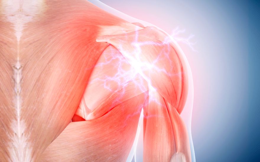 극상근 건염의 구조 (또는 극상근 건염의 병태 구조)