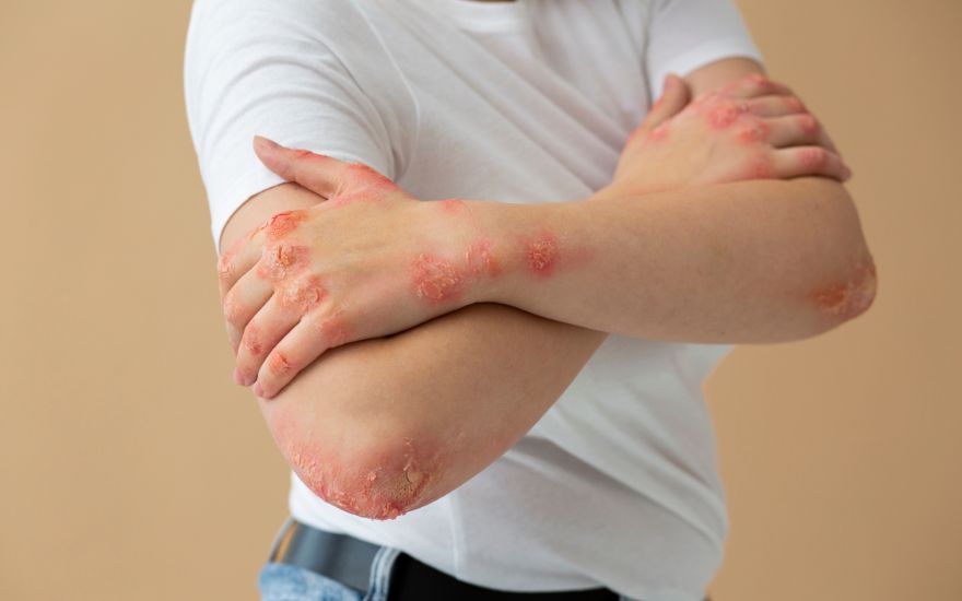 Psoriatic arthritis causes joint inflammation along with red, scaly skin patches.
