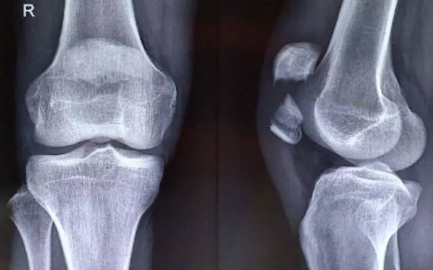 슬개골 골절은 지속적인 염증 반응으로 인해 관절낭 인대의 섬유화 및 석회화를 유발할 수 있습니다