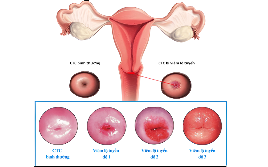 자궁경부미란(자궁경부외반)은 Y존(외음부) 가려움증을 유발할 수 있습니다.