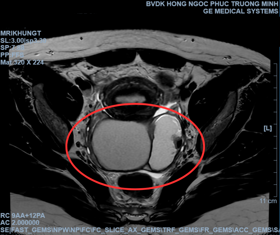 phẫu thuật viêm dính phần phụ