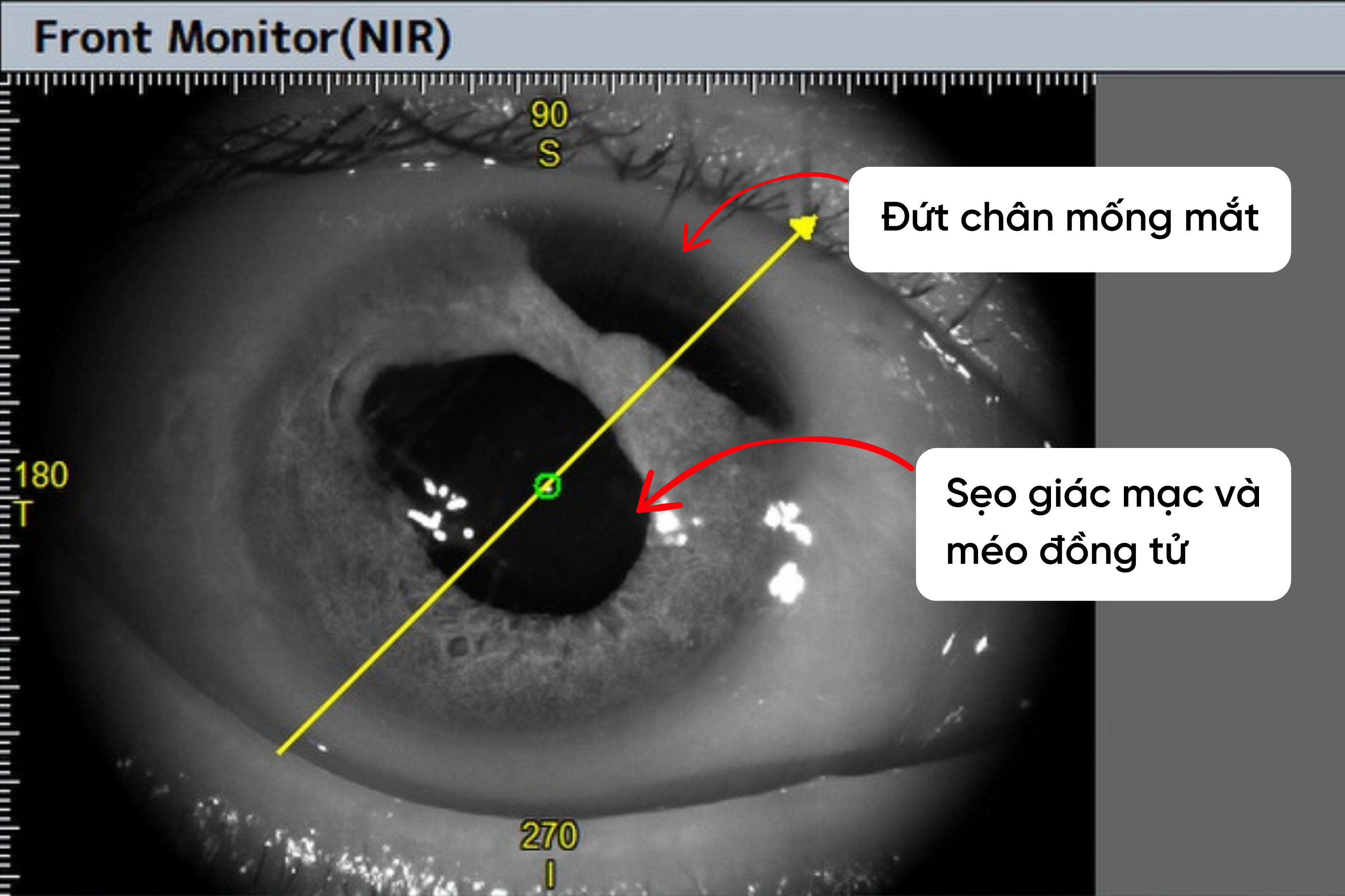 Mắt phải bệnh nhân có nhiều tổn thương nặng sau tai nạn