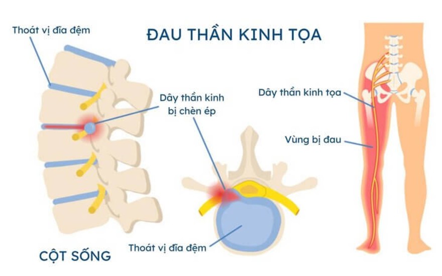 đau thắt lưng
