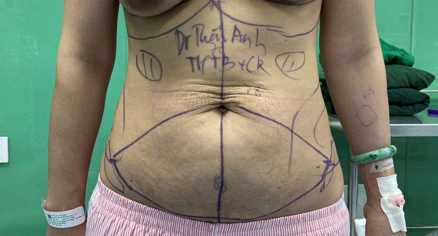 phẫu thuật tạo hình thành bụng