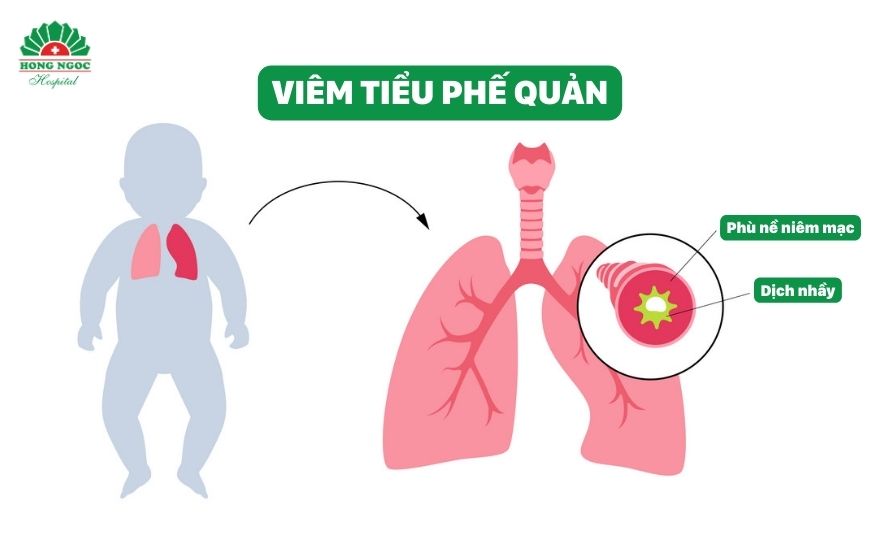 viêm tiểu phế quản ở trẻ sơ sinh