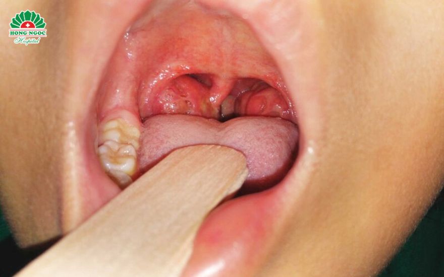 viêm amidan quá phát ở trẻ em