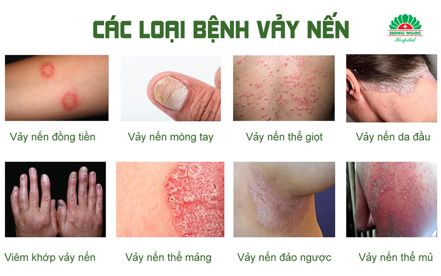 các loại vảy nến