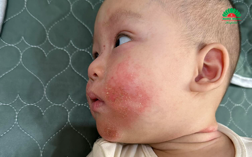 chàm sữa (viêm da cơ địa ở trẻ)