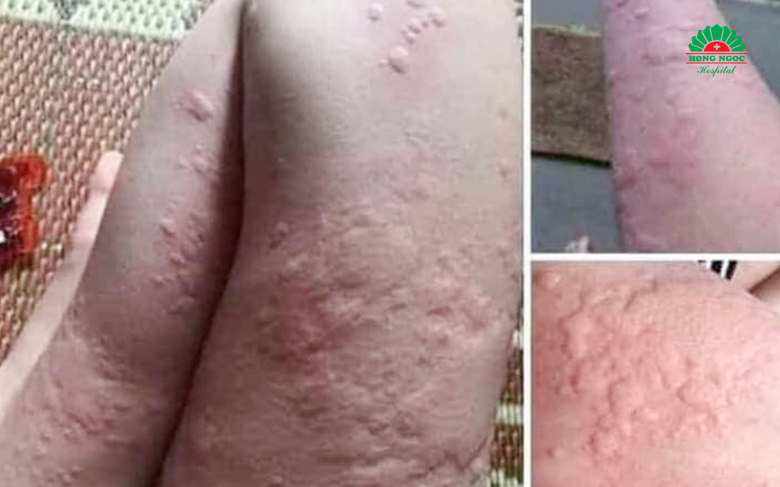 triệu chứng của bệnh mày đay