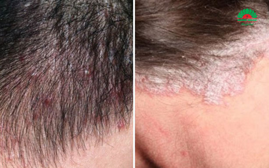 Nấm tóc và da đầu