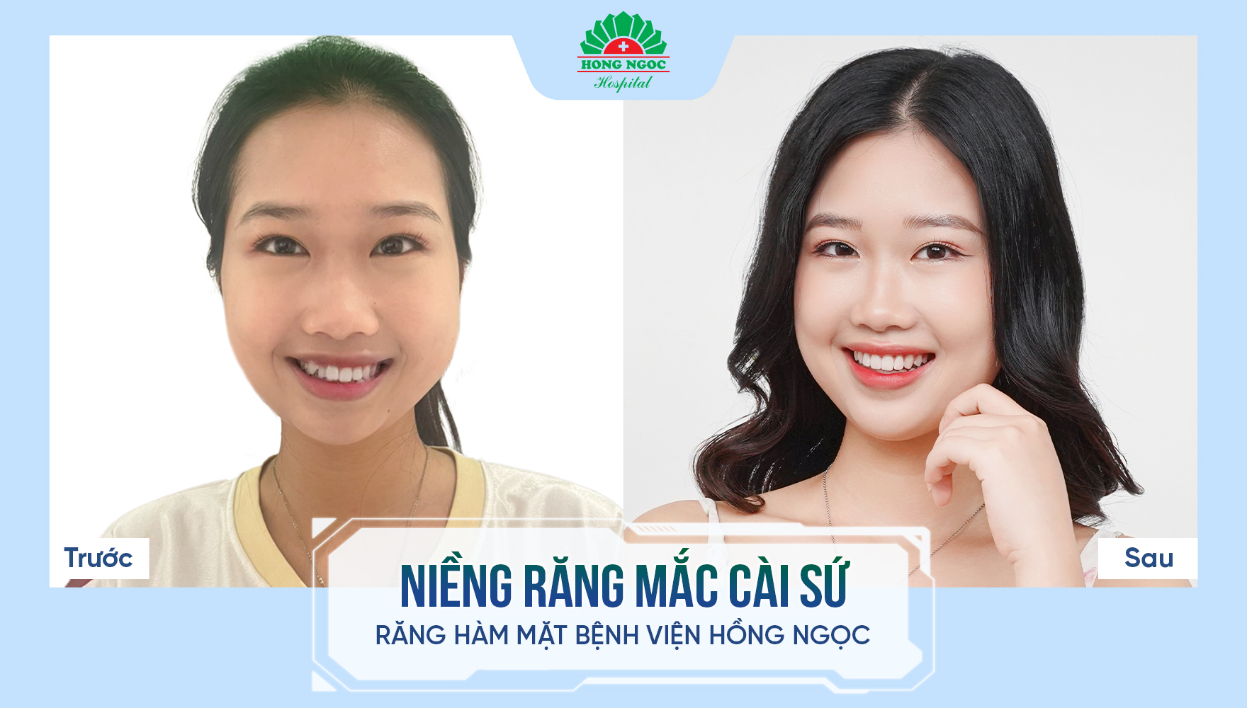 niềng răng mắc cài sứ