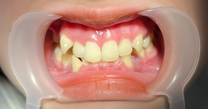 niềng răng sinh học