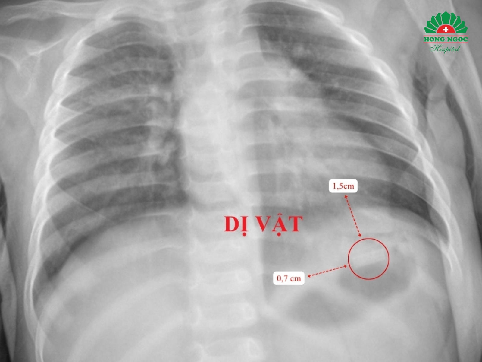 Vị trí dị vật trên phim chụp X-quang