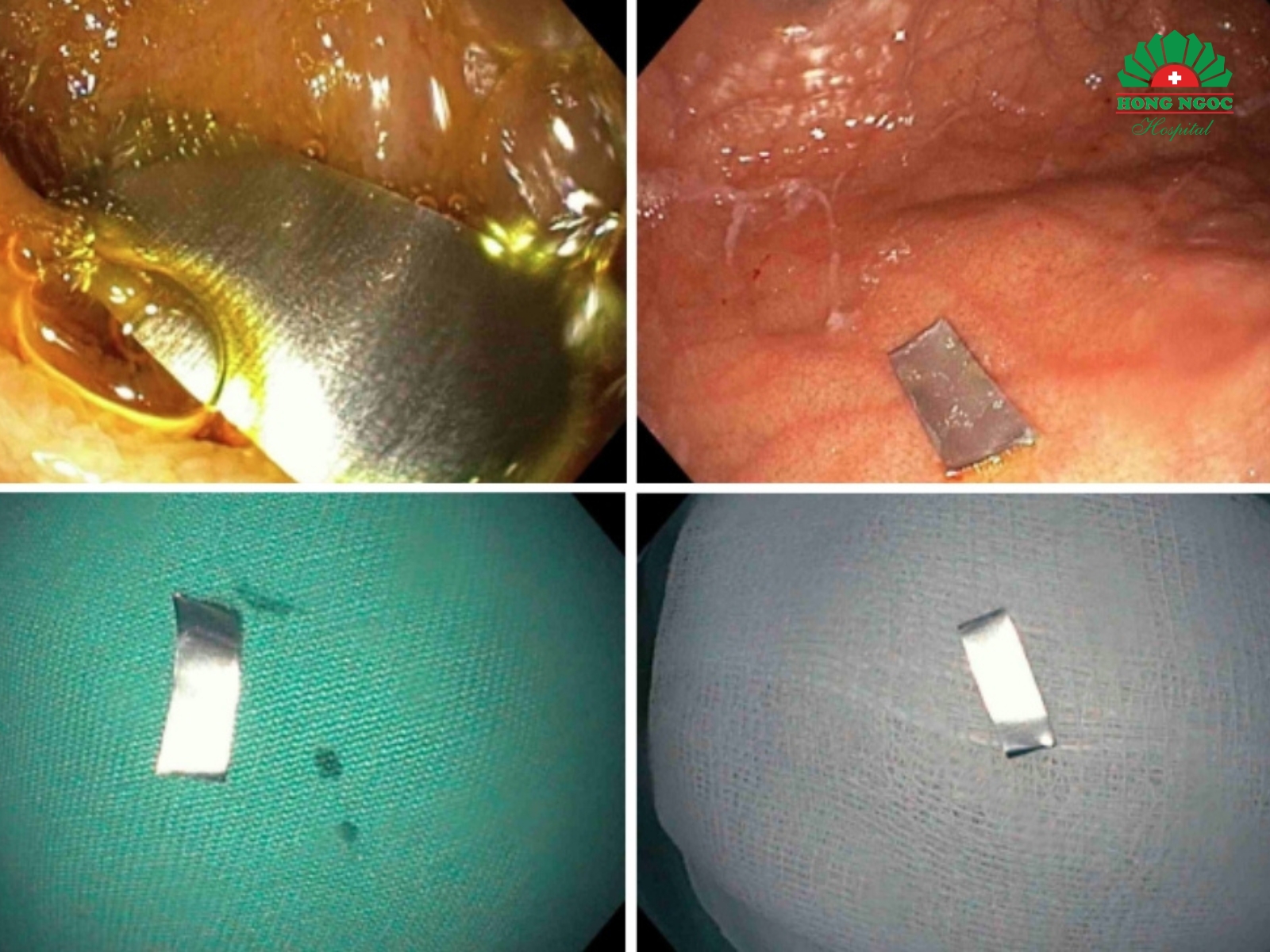 Các bác sĩ thực hiện nội soi, gắp dị vật ra ngoài